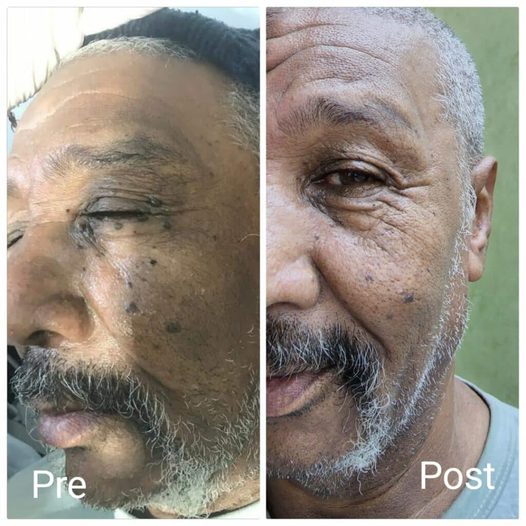 Treatment of skin tags around the eyes